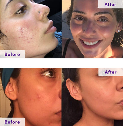 4-Step Acne System